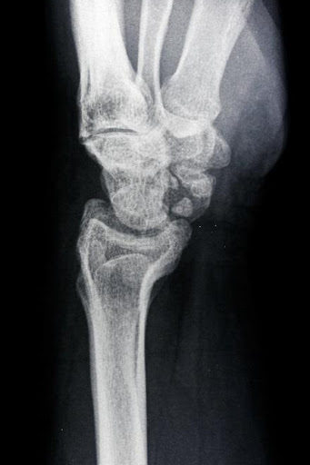 Burmec Bursa El Cerrahisi Microcerrahi BİLEK AĞRISI VE YARALANMALARI