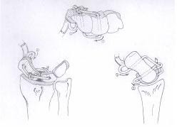 Burmec Bursa El Cerrahisi Microcerrahi BİLEK AĞRISI VE YARALANMALARI