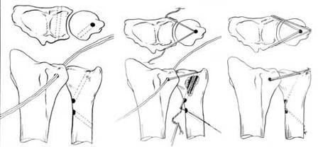 Burmec Bursa El Cerrahisi Microcerrahi BİLEK AĞRISI VE YARALANMALARI