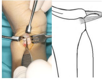 Burmec Bursa El Cerrahisi Microcerrahi BİLEK AĞRISI VE YARALANMALARI
