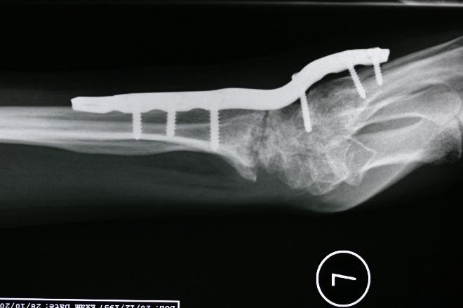 Burmec Bursa El Cerrahisi Microcerrahi BİLEK AĞRISI VE YARALANMALARI