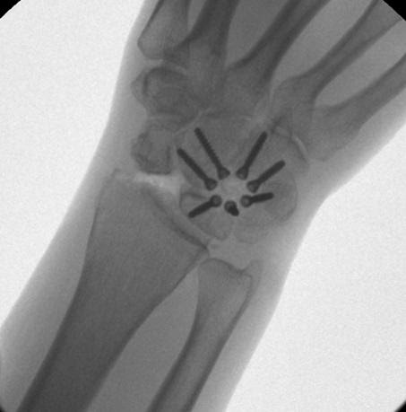 Burmec Bursa El Cerrahisi Microcerrahi BİLEK AĞRISI VE YARALANMALARI