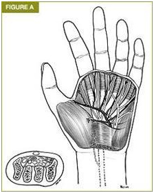 Karpal Tünel Sendromu Tedavisi