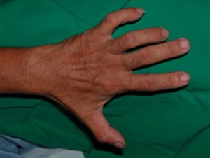 Kübital Tünel Sendromu