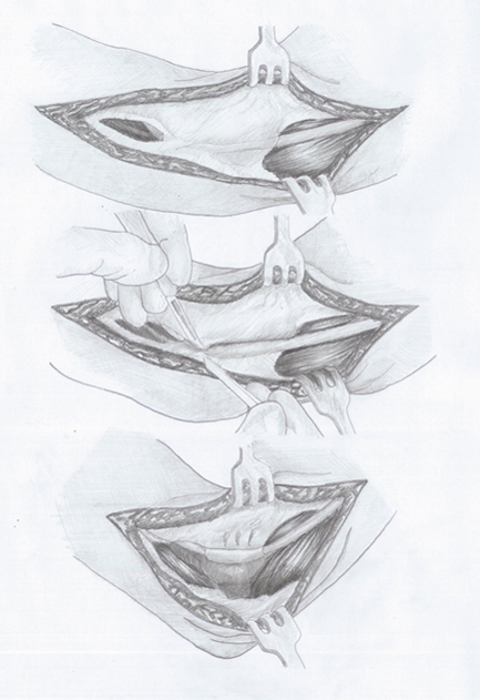 Karpal Tünel Sendromu Tedavisi