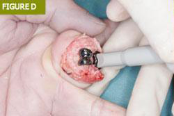 Bursa El Cerrahisi Parmak, El ve Bilekte Yapay Eklem Değiştirme, Bilek Protezi