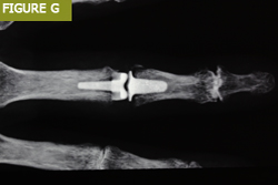 Bursa El Cerrahisi Parmak, El ve Bilekte Yapay Eklem Değiştirme, Bilek Protezi