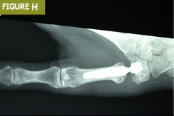 Bursa El Cerrahisi Parmak, El ve Bilekte Yapay Eklem Değiştirme, Bilek Protezi