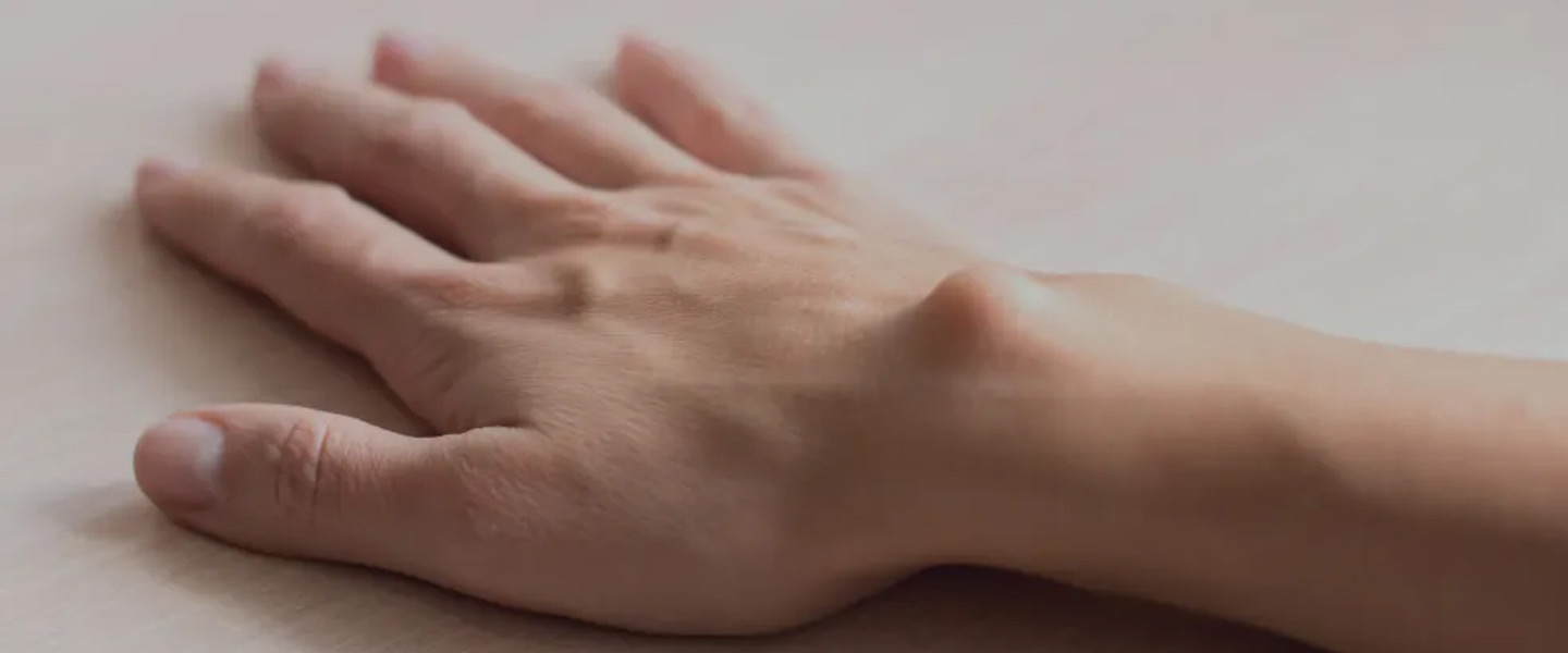 Ganglion (El Bileği) Kisti