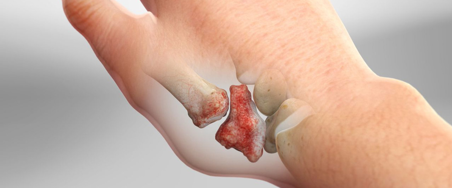 KARPOMETAKARPAL EKLEM OSTEOARTRİTİ , Karpometakarpal Eklem Artrozu