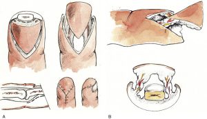 Parmak Ucu Yaralanmaları Burmec Bursa El Cerrahisi Microcerrahi