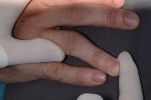 Sporda Parmak Eklem Yaralanmaları