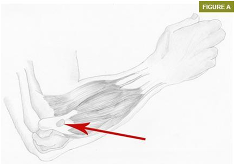 Tenişçi dirseği Lateral Epikondilit