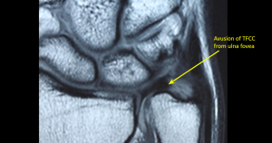 Üçgen Fibrokartilage Kompleksi, TFCC Bilek Yaralanması